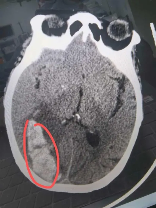 突发视力下降病例经转诊发现脑出血（原报道配图）